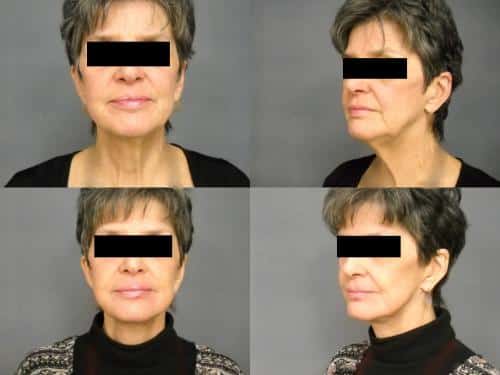 Face Lift Case #391 Combined Image