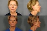 Face Lift Case #981 Combined Image