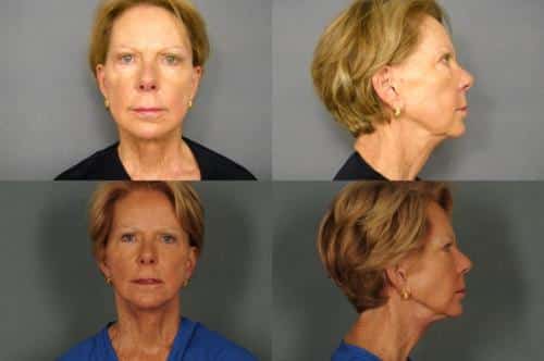 Face Lift Case #981 Combined Image