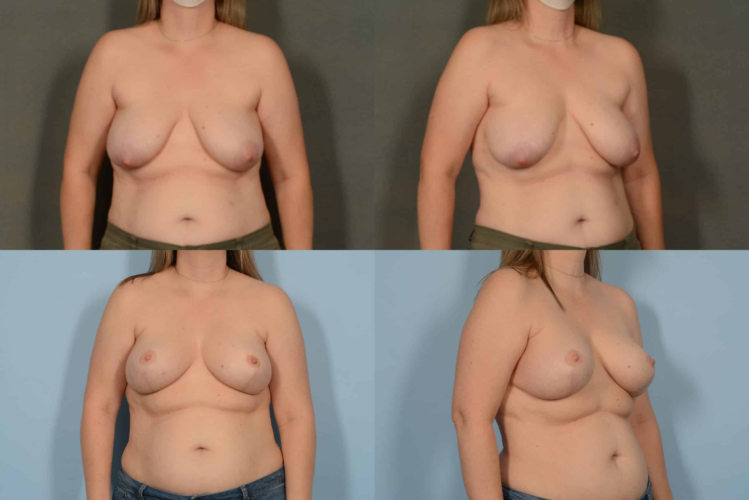 Breast Lift with Augmentation Case# 1060 Combined Image