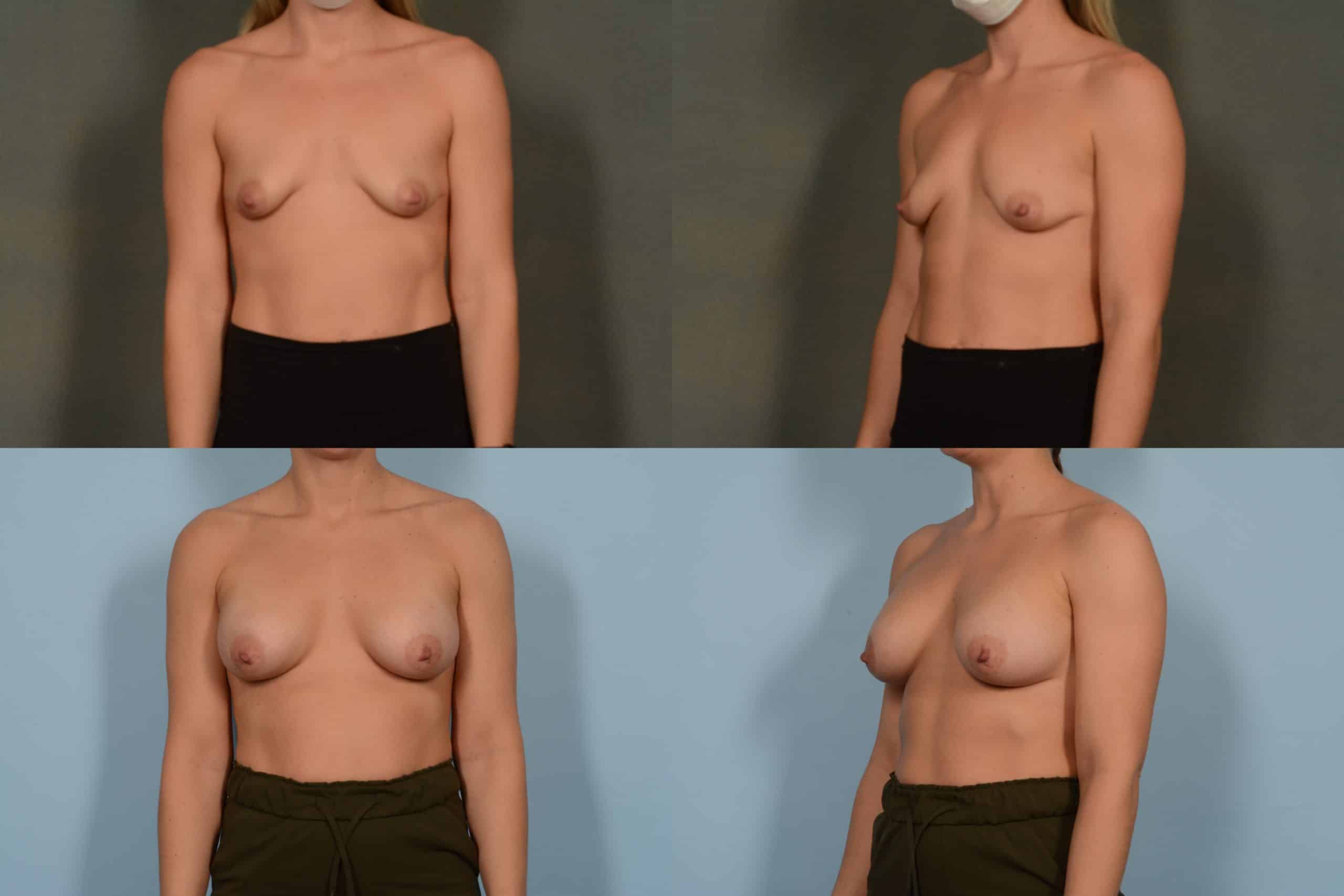 Breast Augmentation Case# 1061 Combined Image