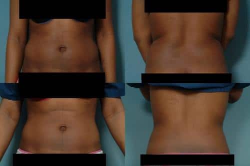Liposuction Case #135 Combined Image