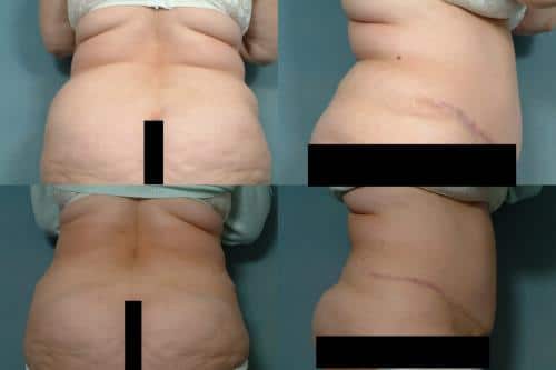 Liposuction Case #136 Combined Image