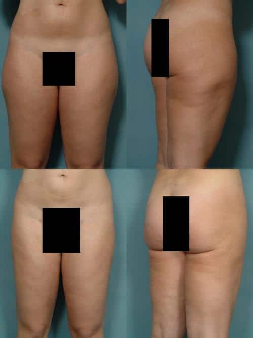 Liposuction Case #137 Combined Image