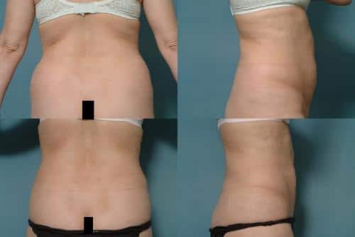 Liposuction Case #138 Combined Image