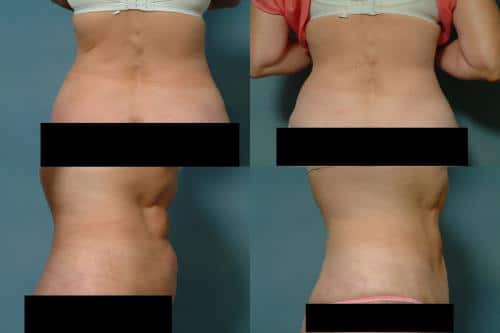 Liposuction Case #139 Combined Image
