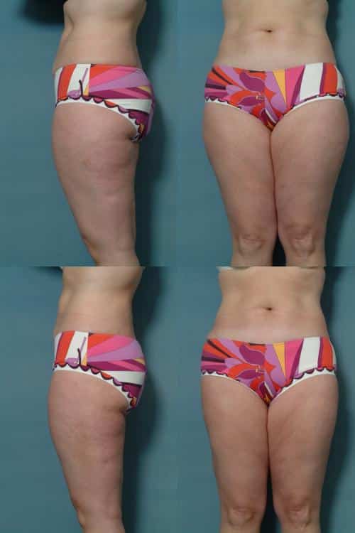 Liposuction Case #140 Combined Image