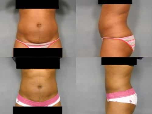 Liposuction Case #150 Combined Image