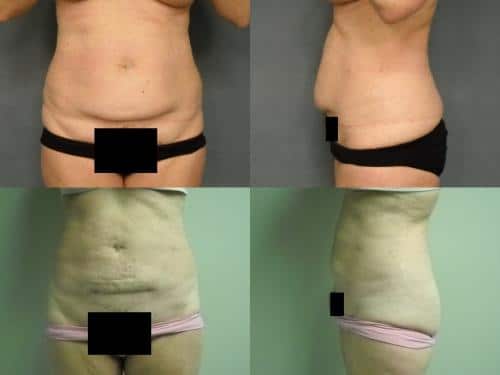 Liposuction Case #153 Combined Image