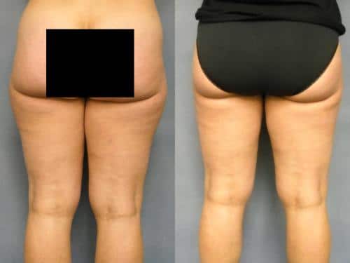 Liposuction Case #205 Combined Image