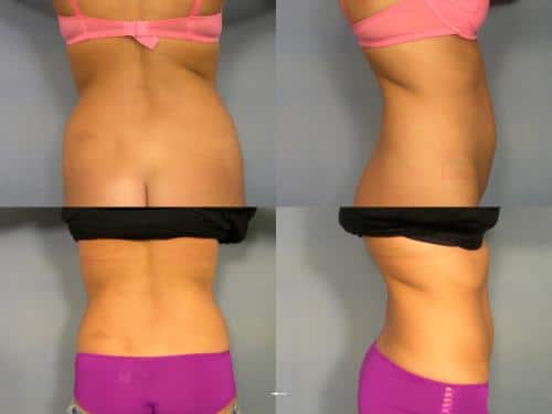 Liposuction Case #211 Combined Image