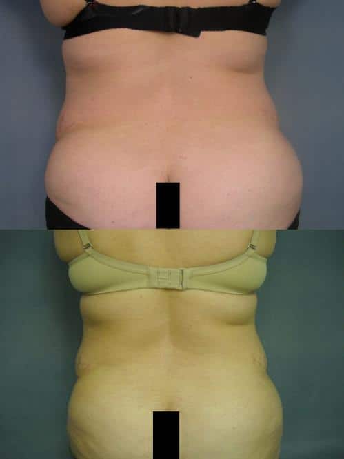 Liposuction Case #212 Combined Image