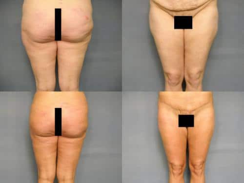 Liposuction Case #222 Combined Image