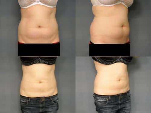 Liposuction Case #234 Combined Image