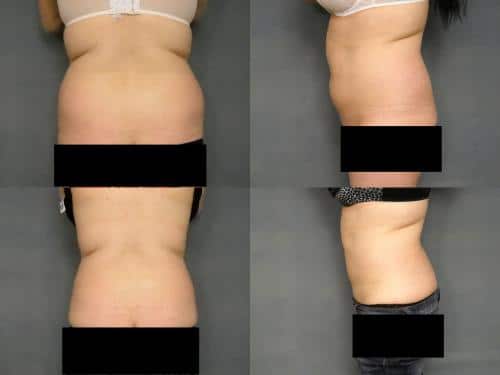 Liposuction Case #235 Combined Image