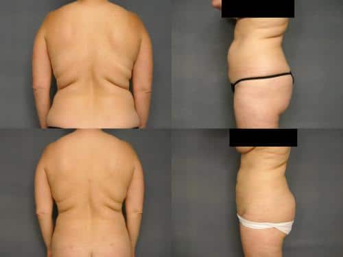Liposuction Case #273 Combined Image