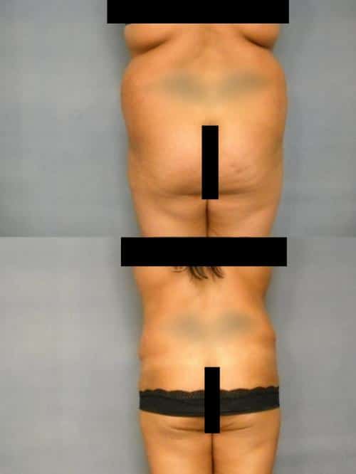 Liposuction Case #292 Combined Image