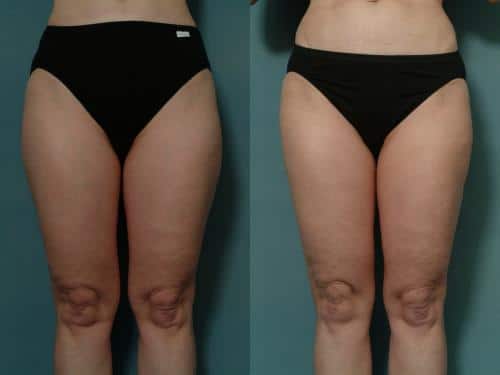 Liposuction Case #601 Combined Image