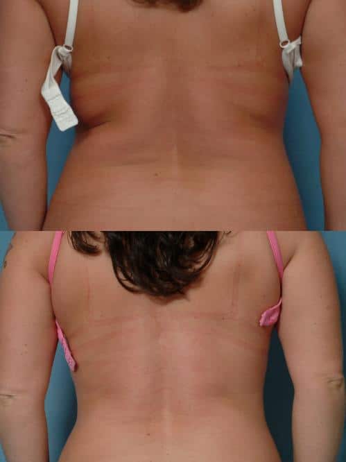 Liposuction Case #761 Combined Image