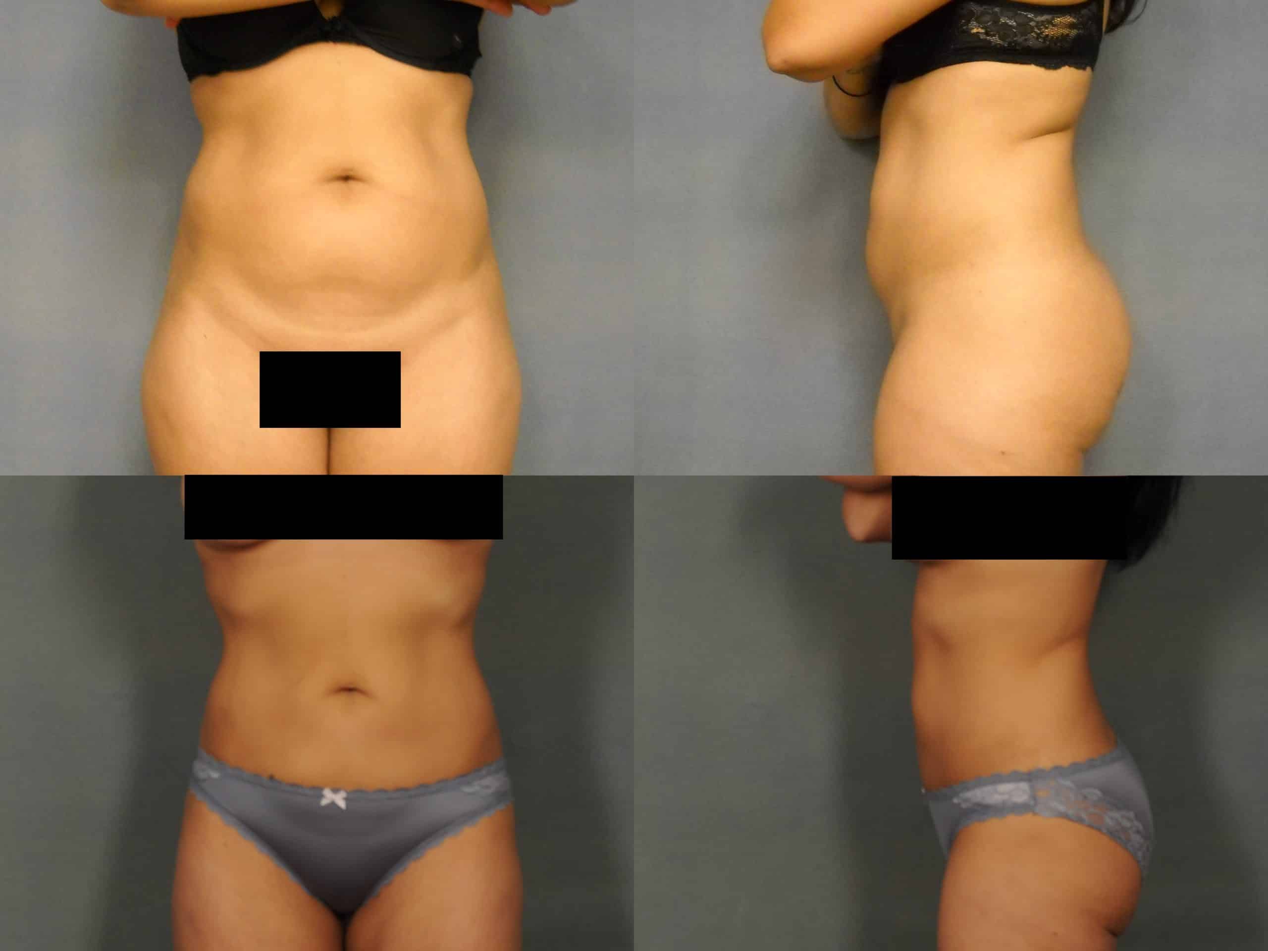 Liposuction Case #762 Combined Image
