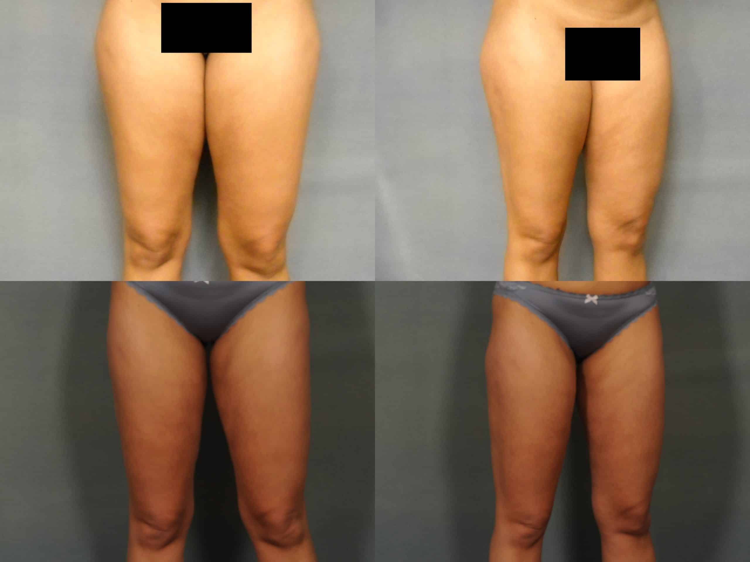 Liposuction Case #763 Combined Image