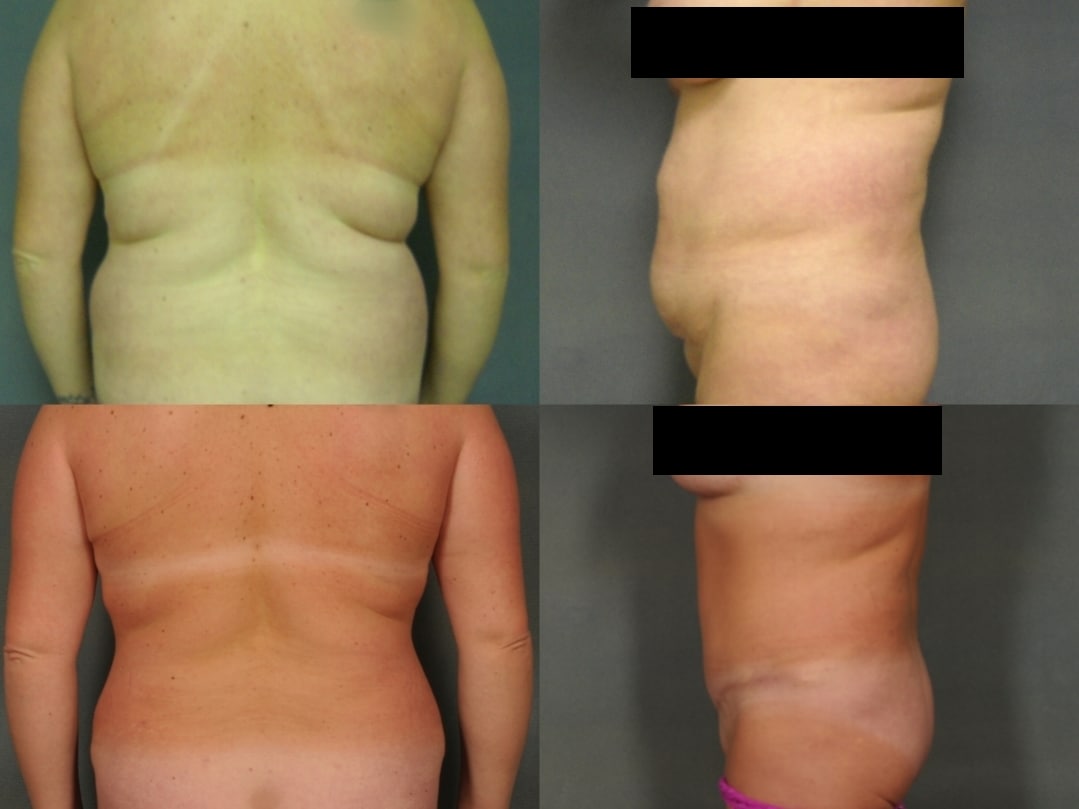 Liposuction Case# 775 Combined Image