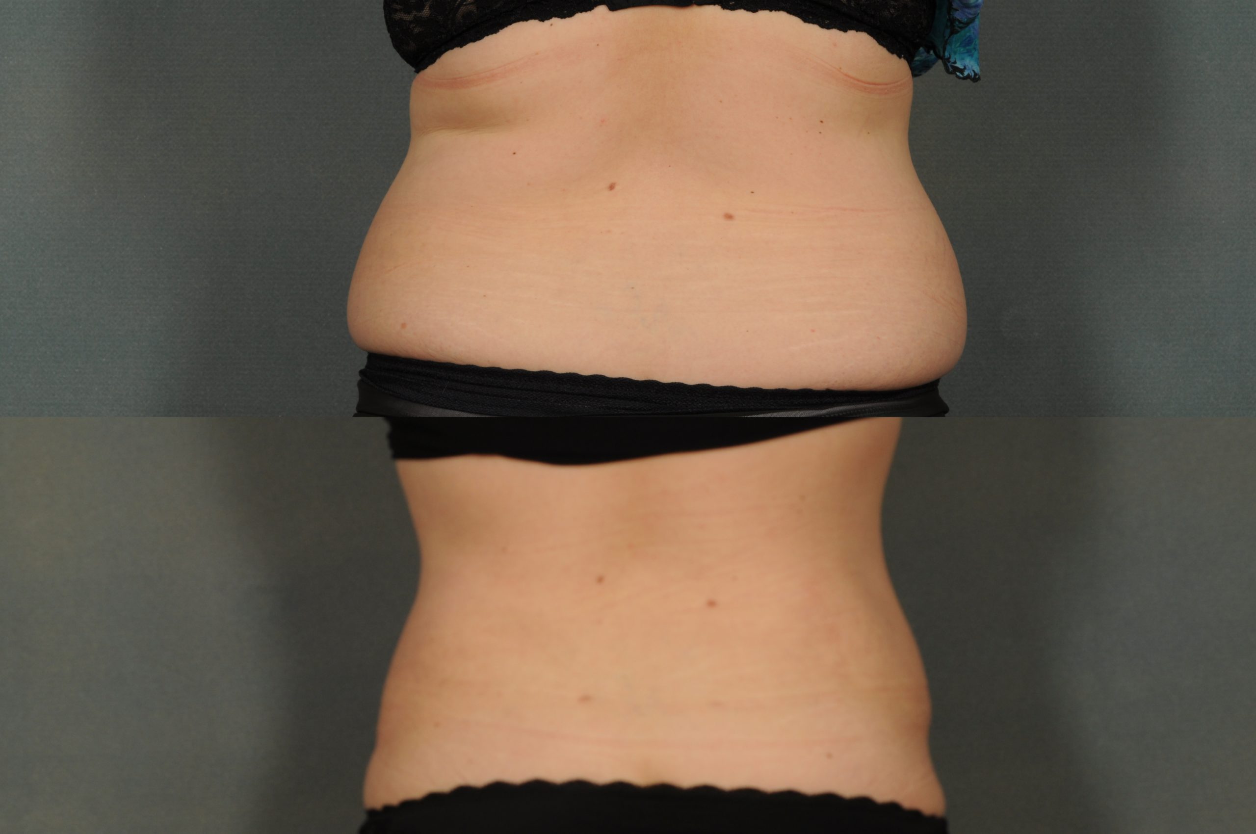 Liposuction Case# 785 Combined Image