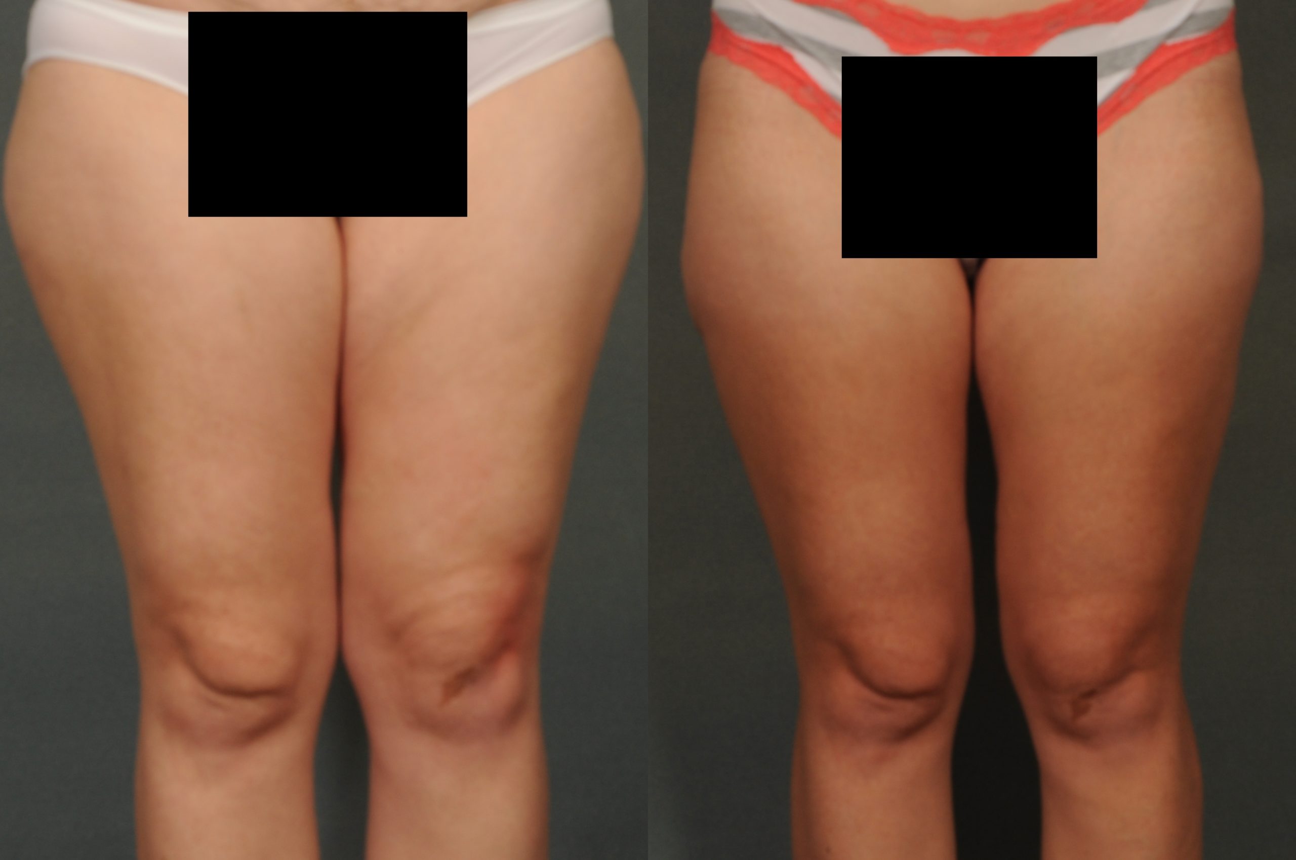 Liposuction Case# 800 Combined Image