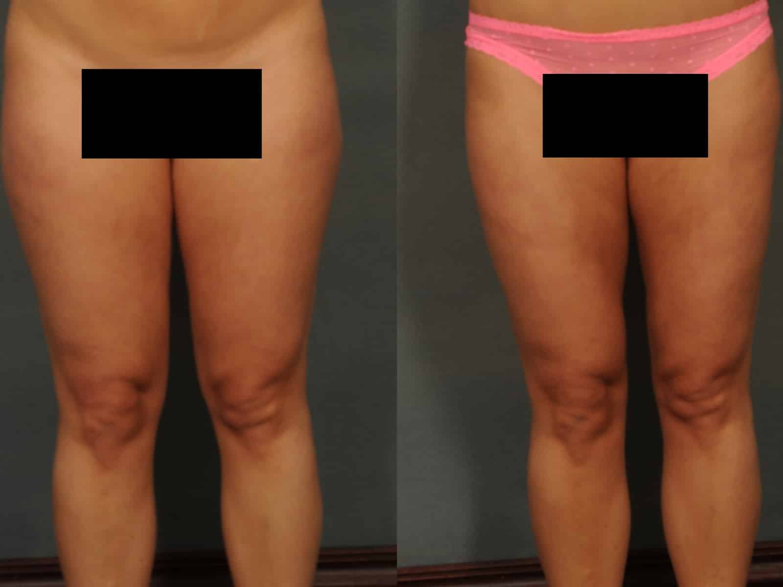 Liposuction Case# 833 Combined Image