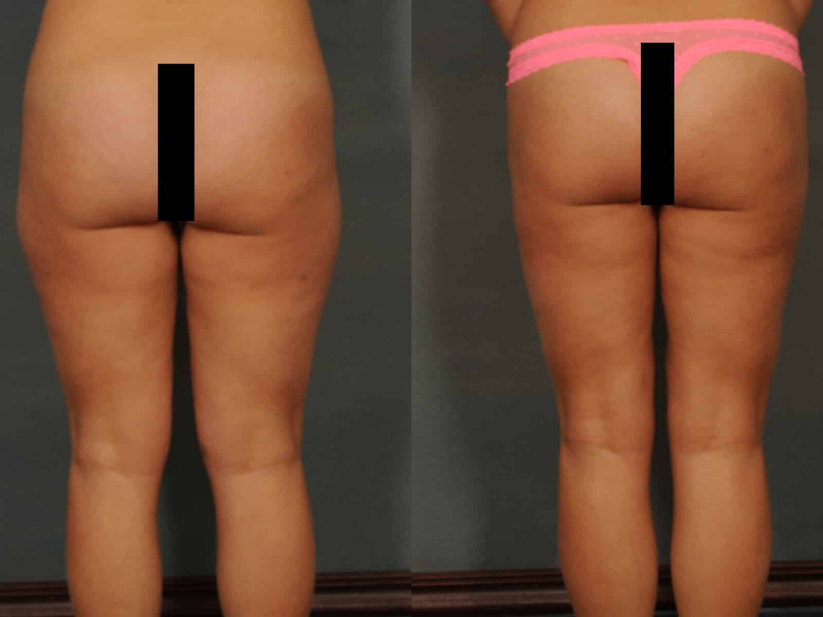 Liposuction Case# 834 Combined Image