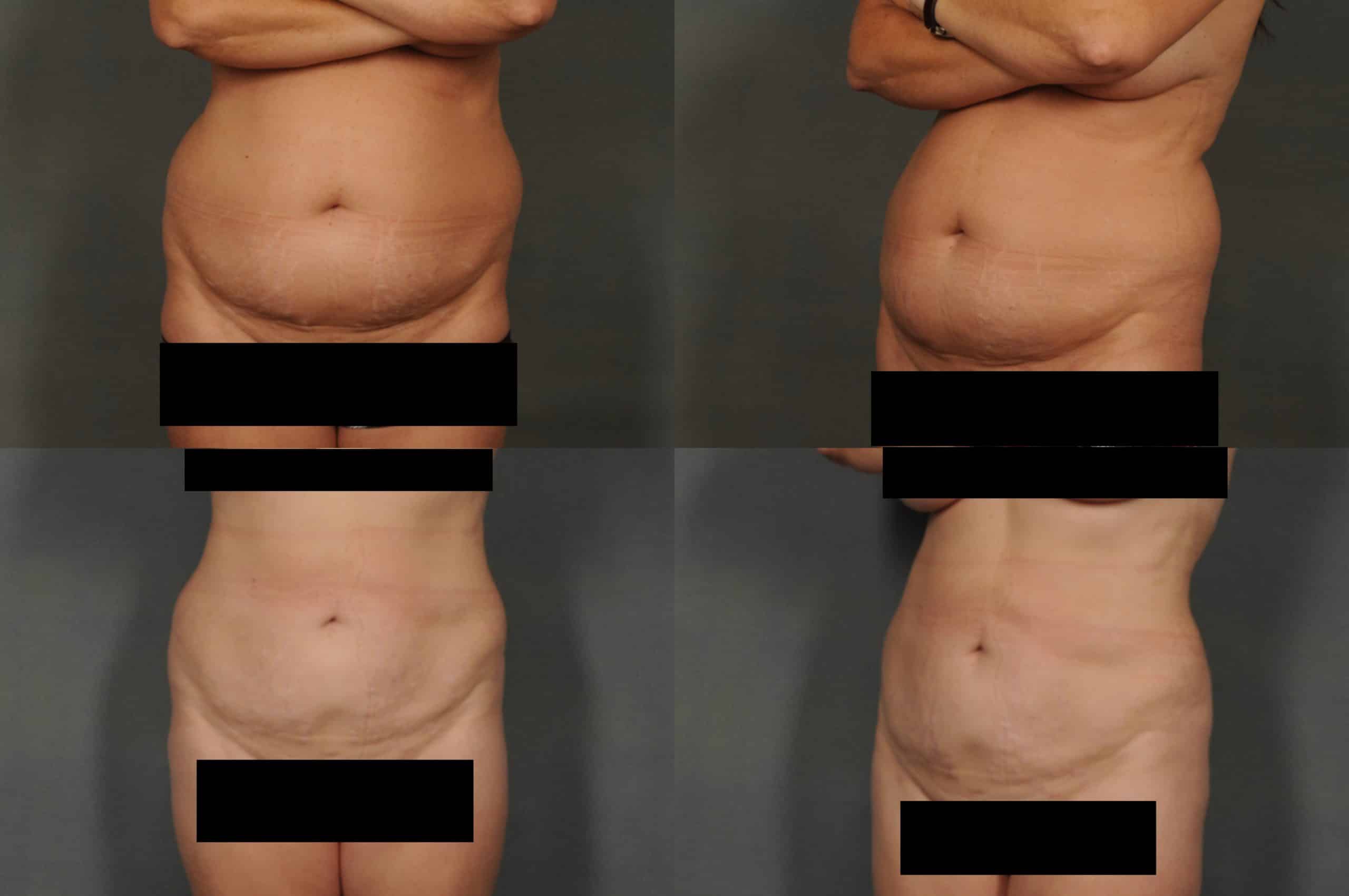 Liposuction Case #869 Combined Image