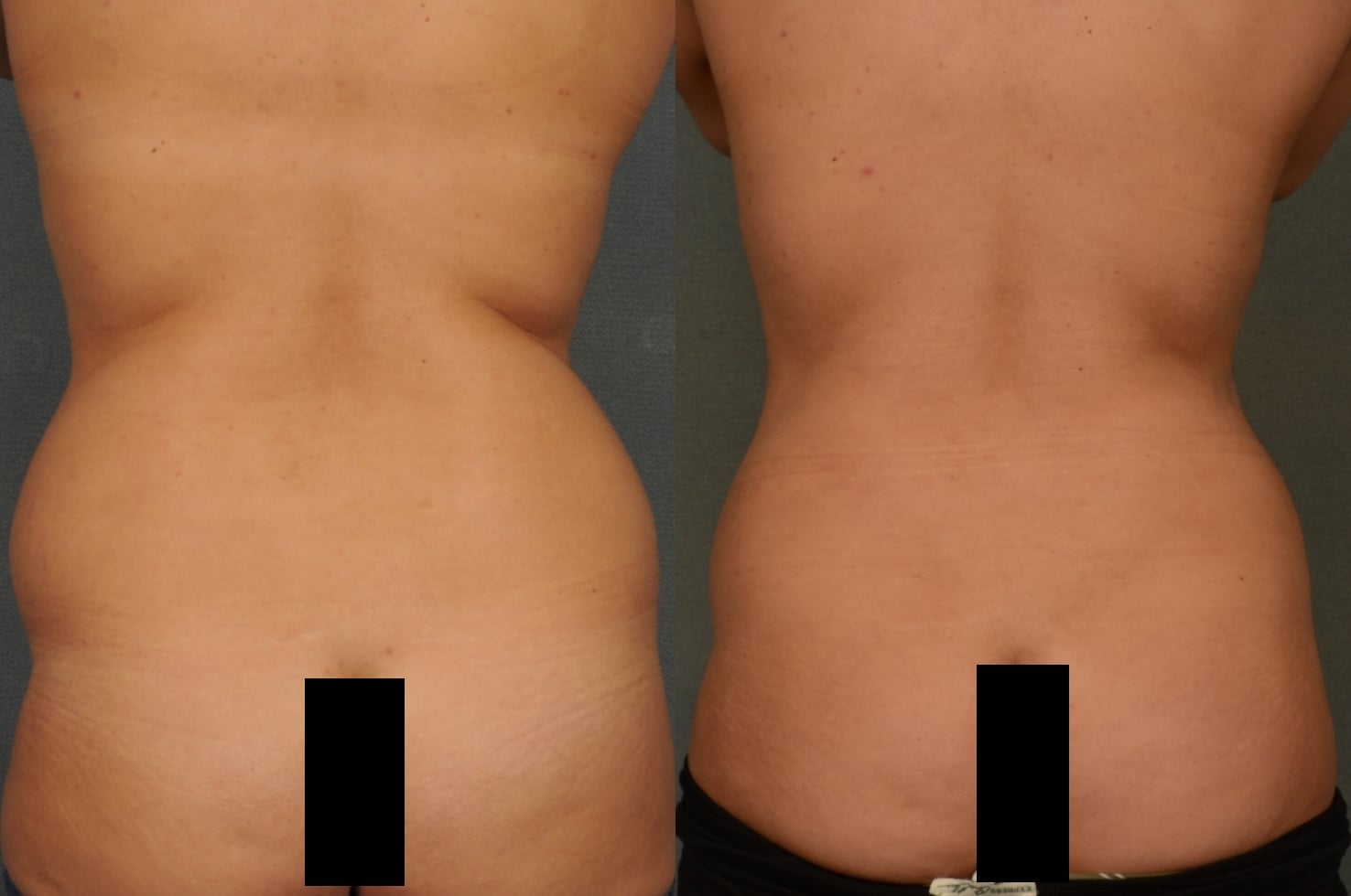 Liposuction Case# 944 Combined Image
