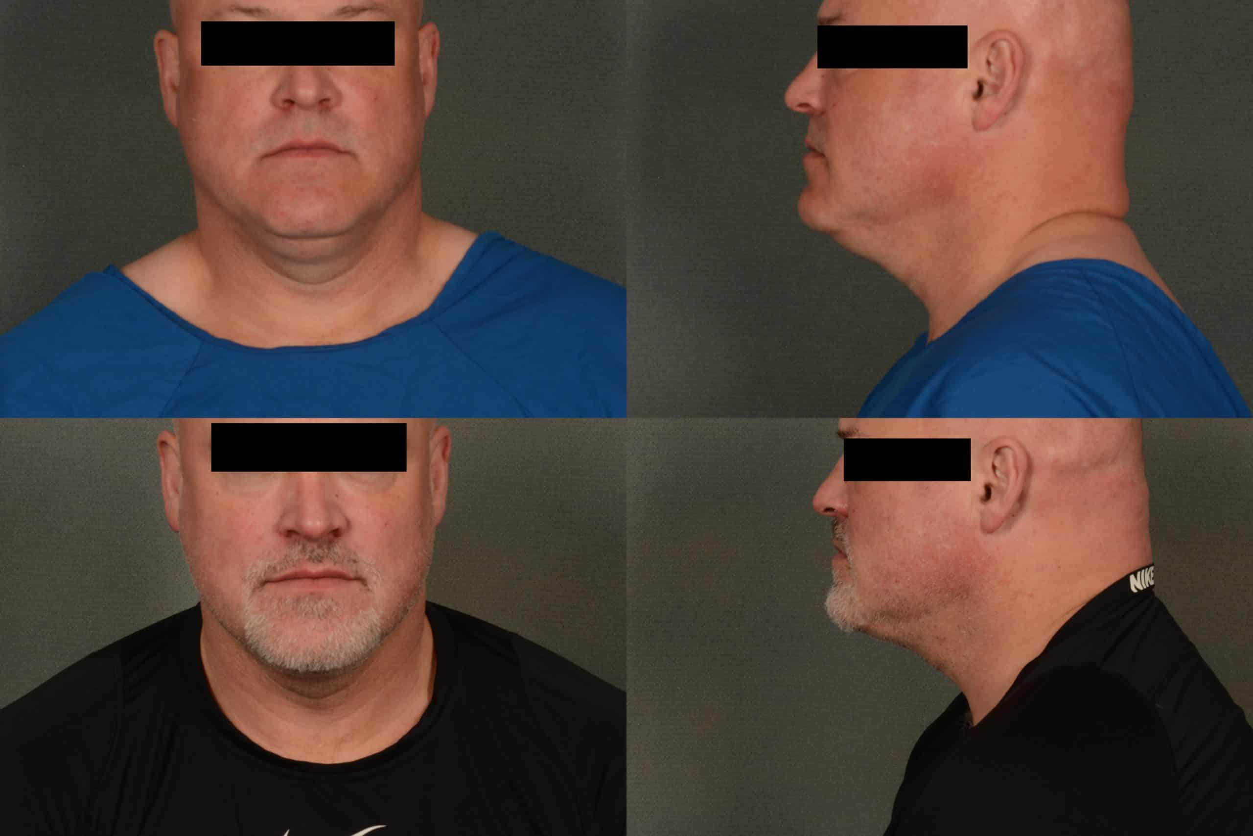 Liposuction Case# 945 Combined Image