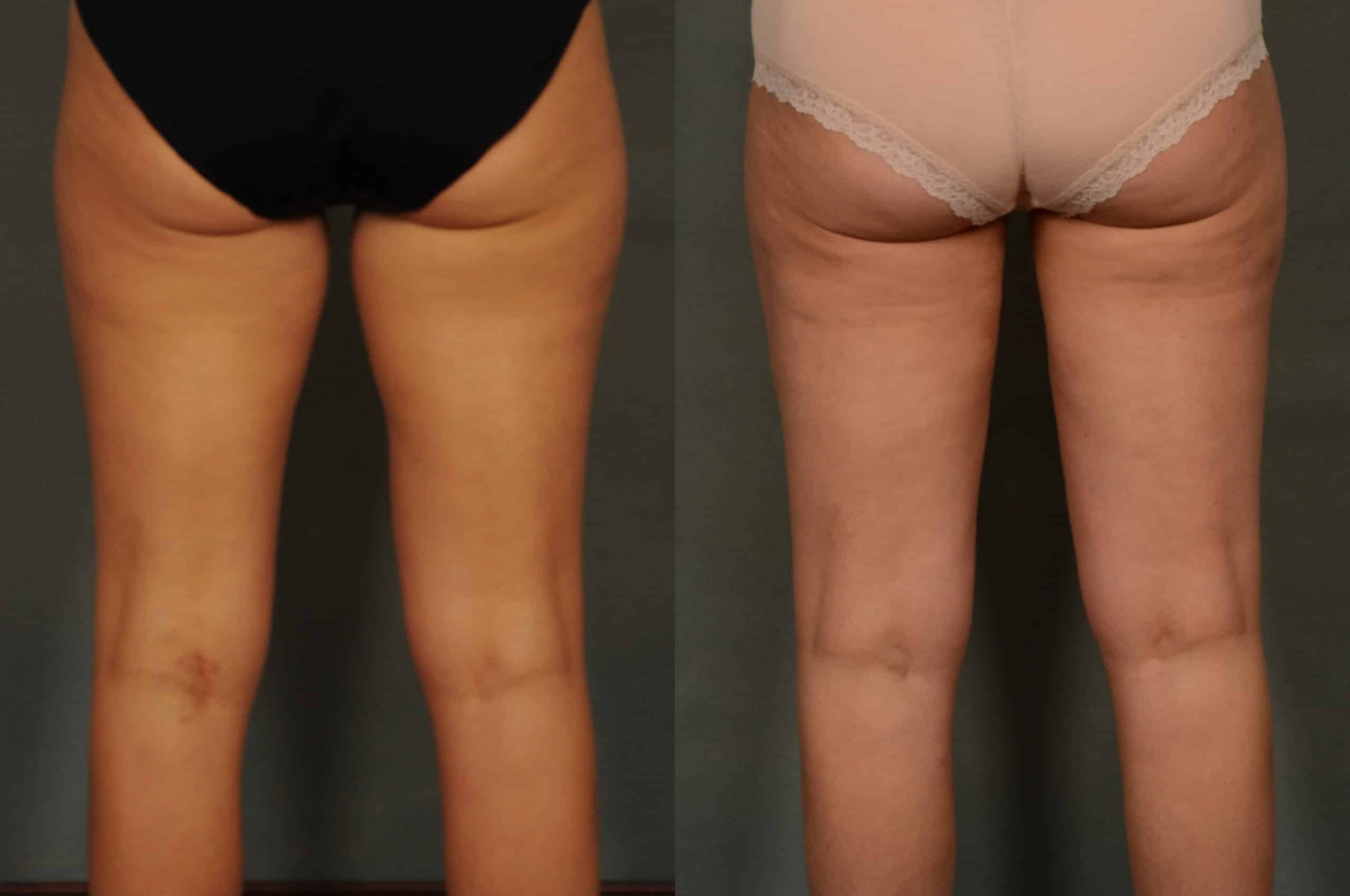 Liposuction Case# 948 Combined Image