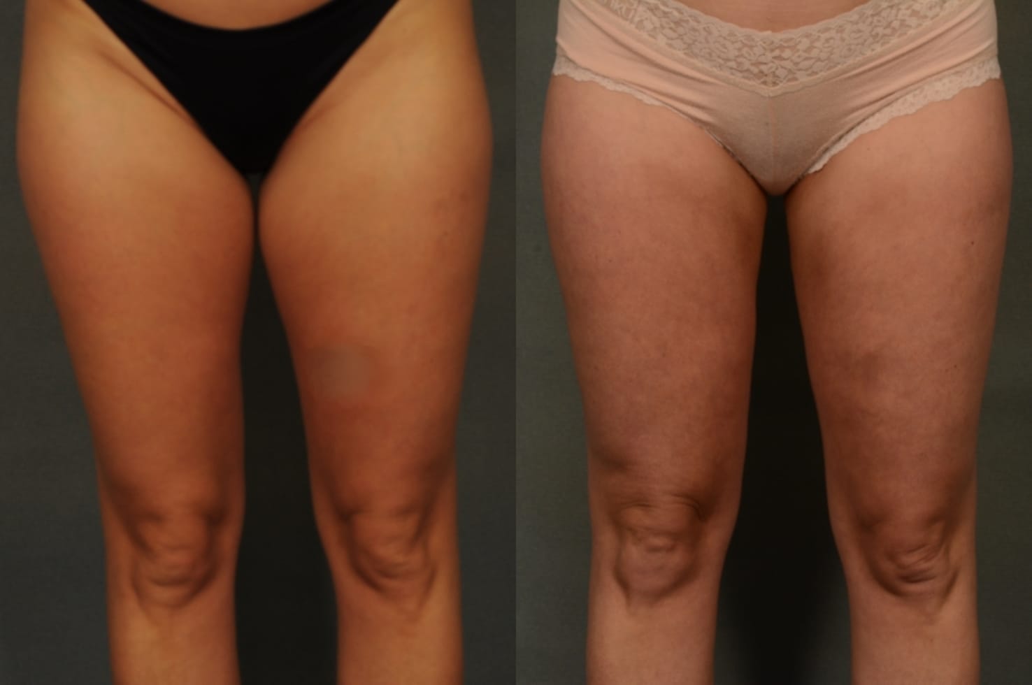 Liposuction Case #949 Combined Image