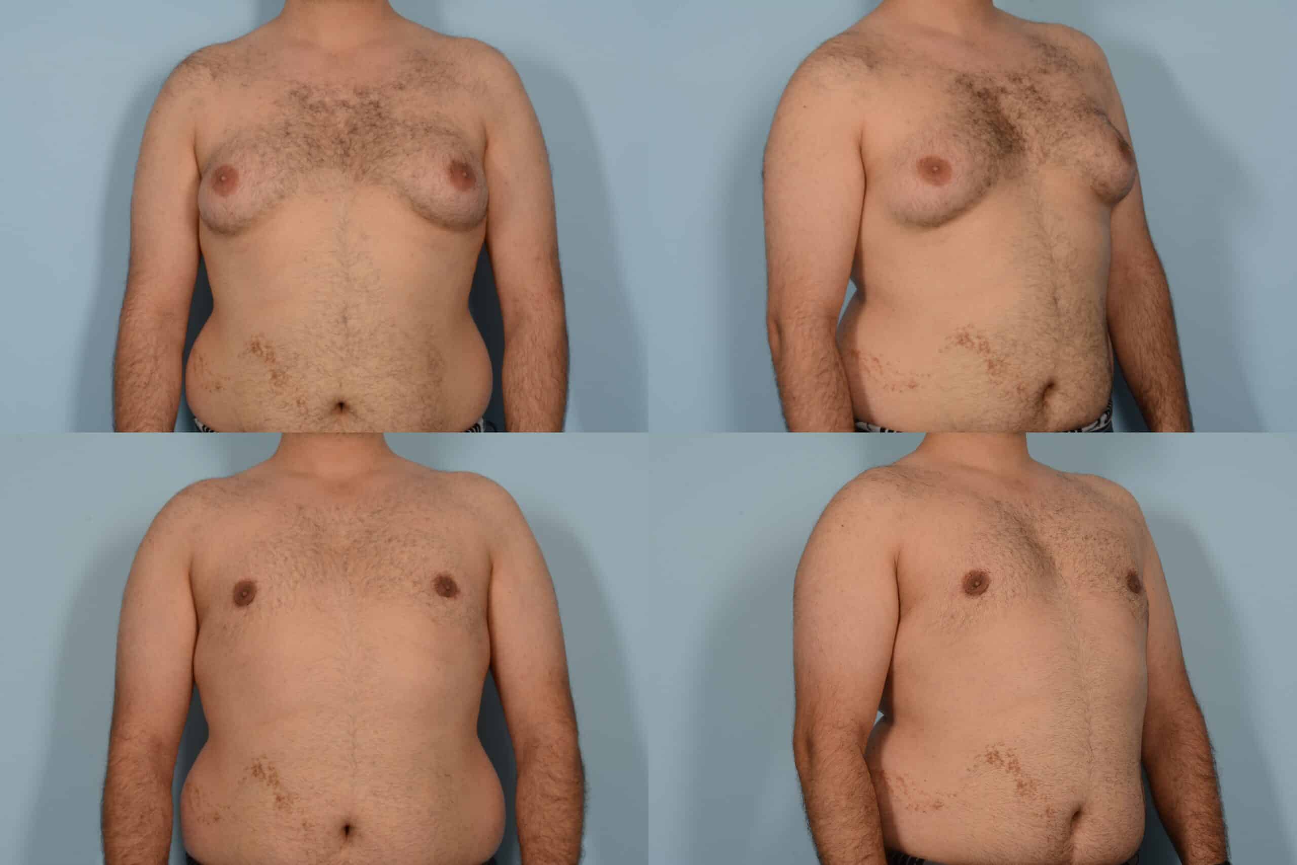 Male Breast Reduction Case# 1155 Combined Image