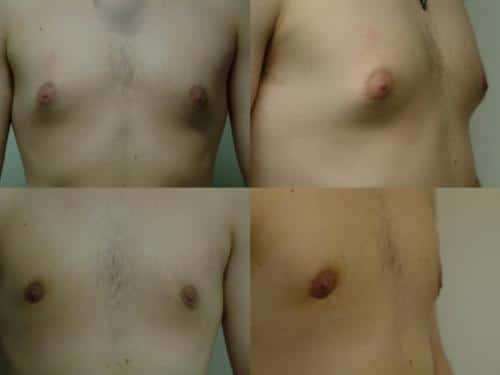 Male Breast Reduction Case #148 Combined Image