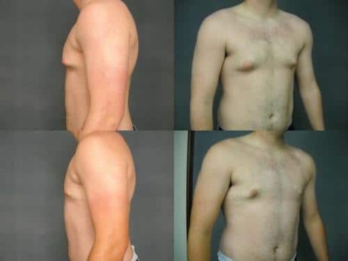Male Breast Reduction Case #193 Combined Image