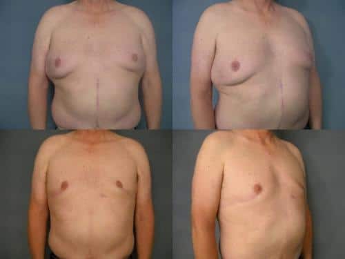 Male Breast Reduction Case #210 Combined Image