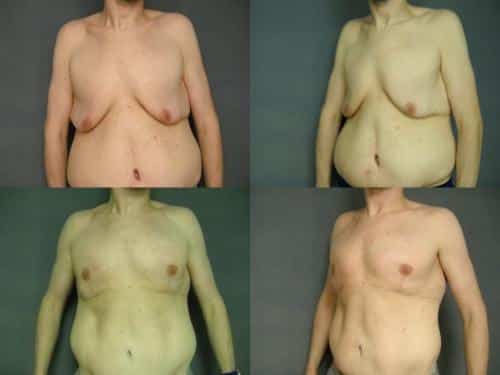 Male Breast Reduction Case #258 Combined Image