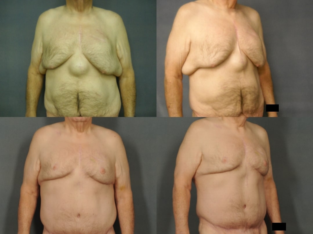 Male Breast Reduction Case# 770 Combined Image