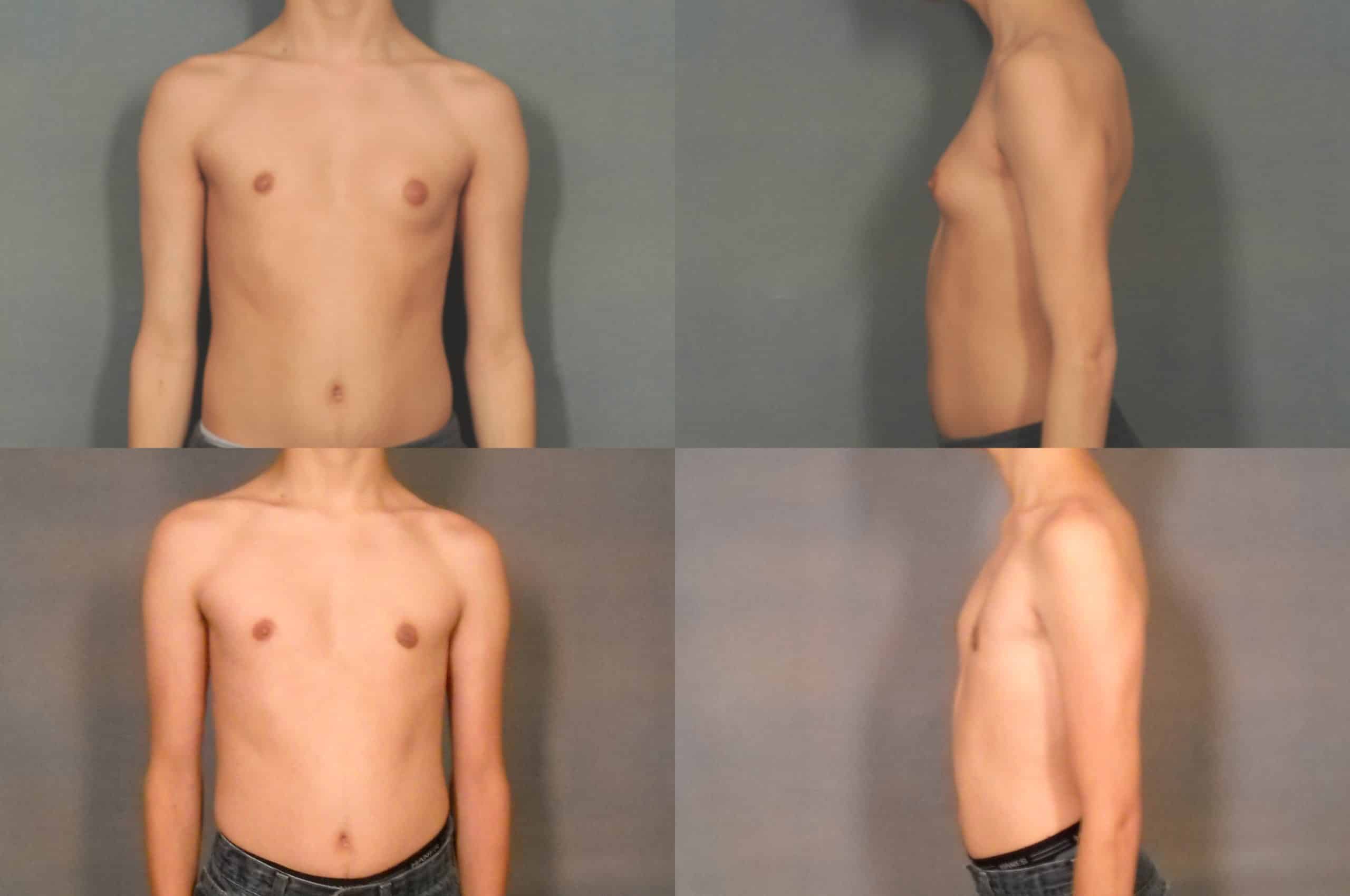 Male Breast Reduction Case# 805 Combined Image