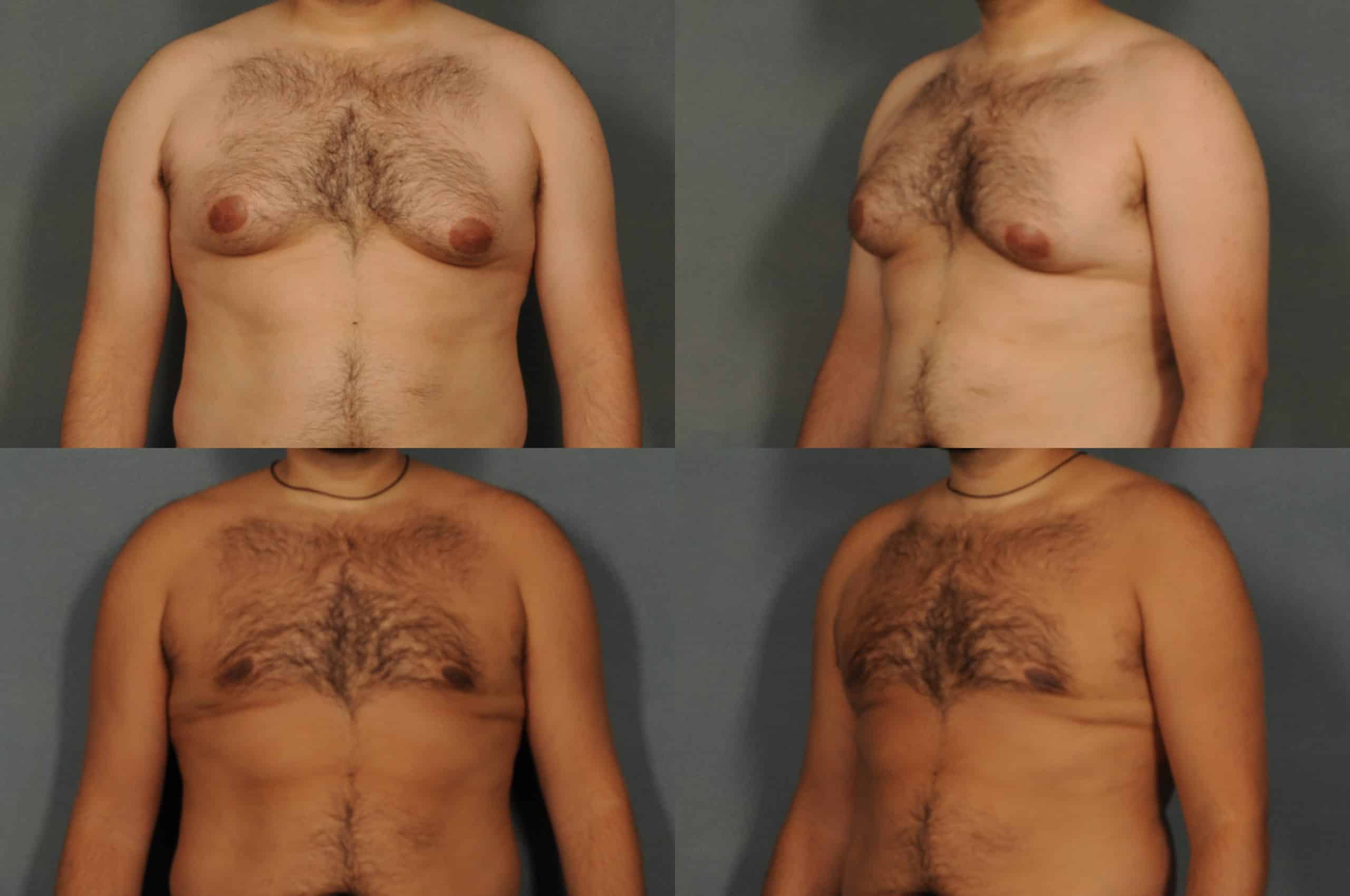 Male Breast Reduction Case# 870 Combined Image