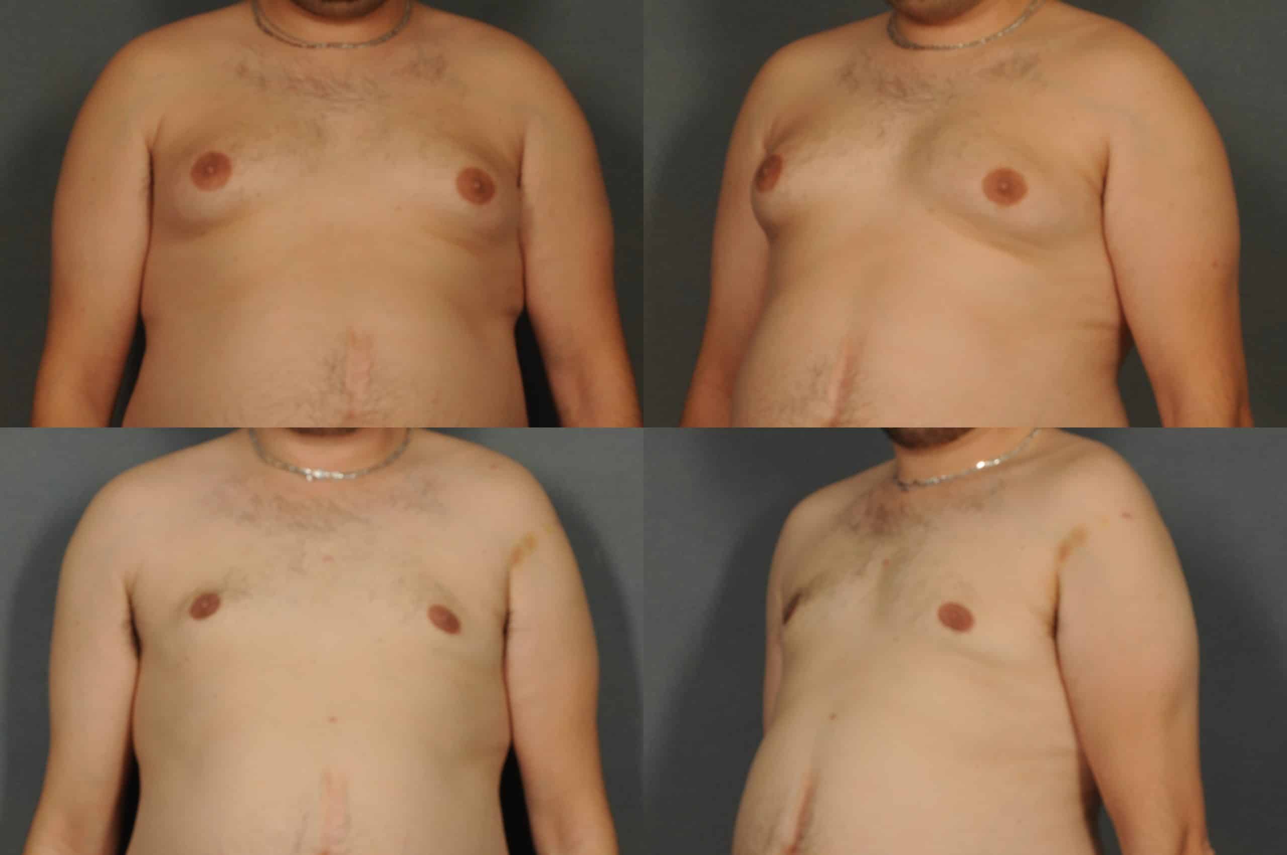 Male Breast Reduction Case# 876 Combined Image