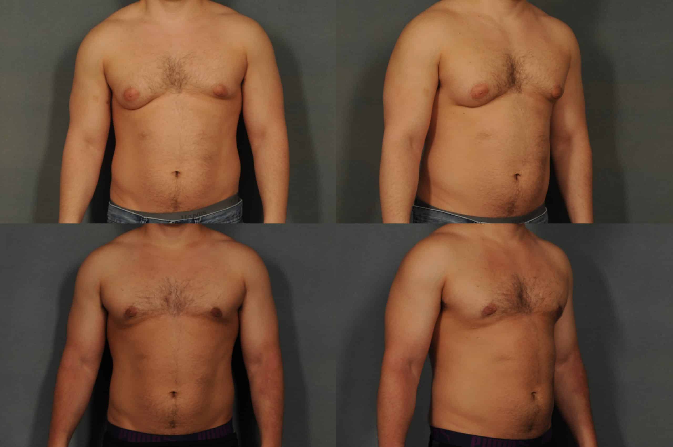 Male Breast Reduction Case# 881 Combined Image