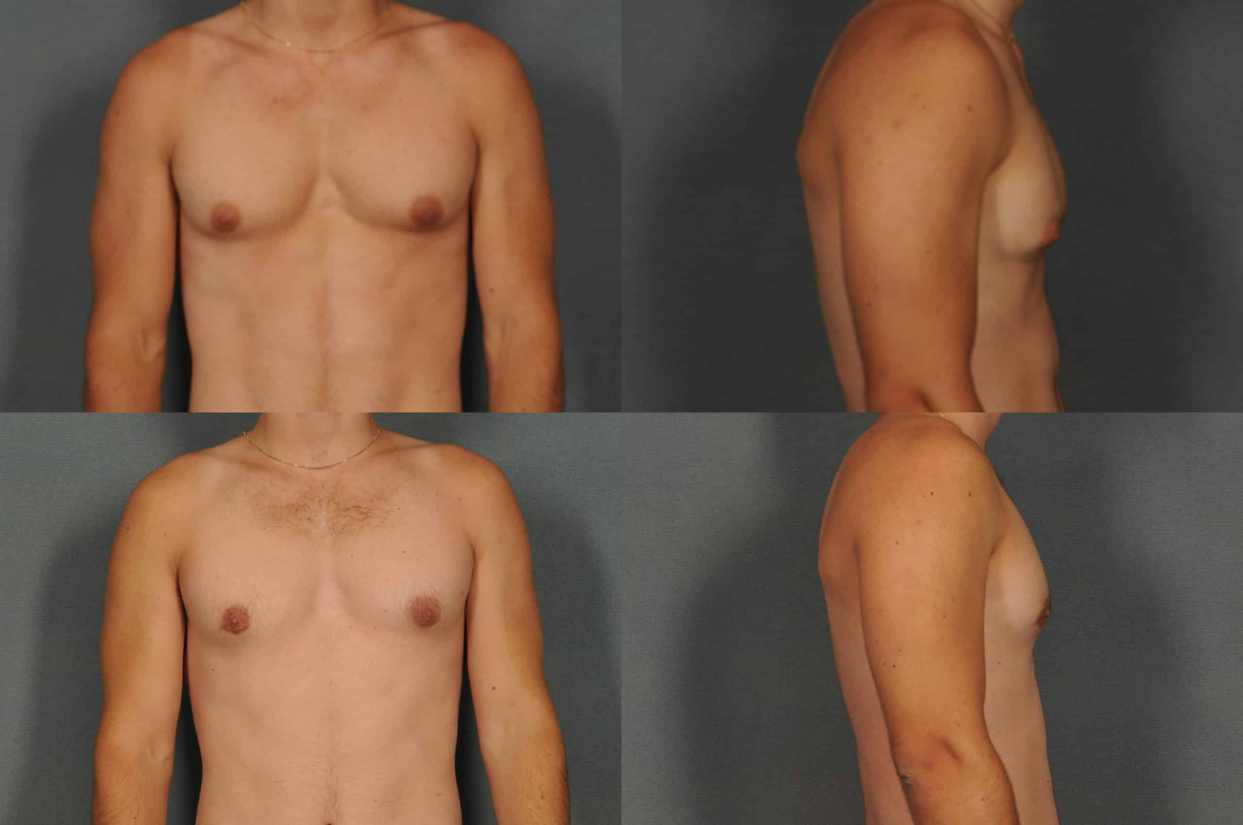 Male Breast Reduction Case# 889 Combined Image