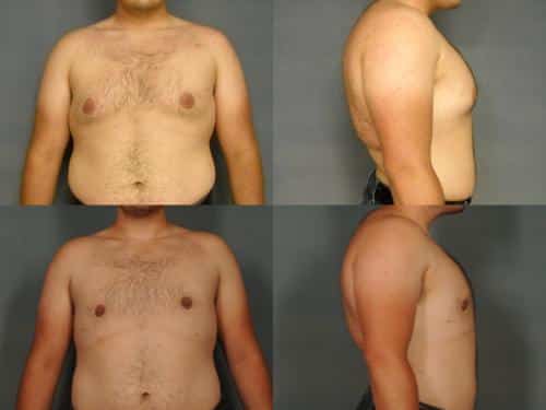 Male Breast Reduction Case #931 Combined Image