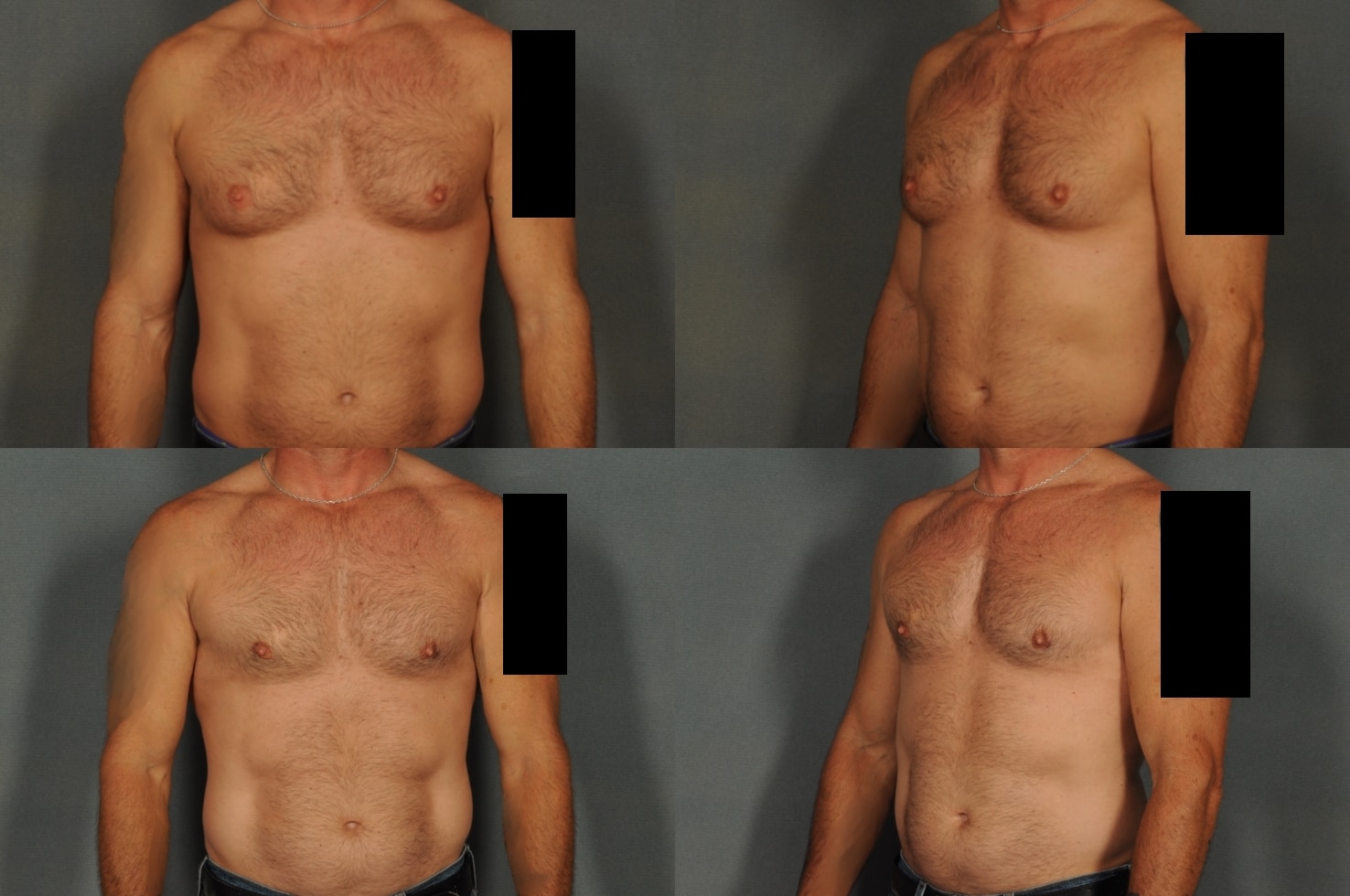 Male Breast Reduction Case# 935 Combined Image