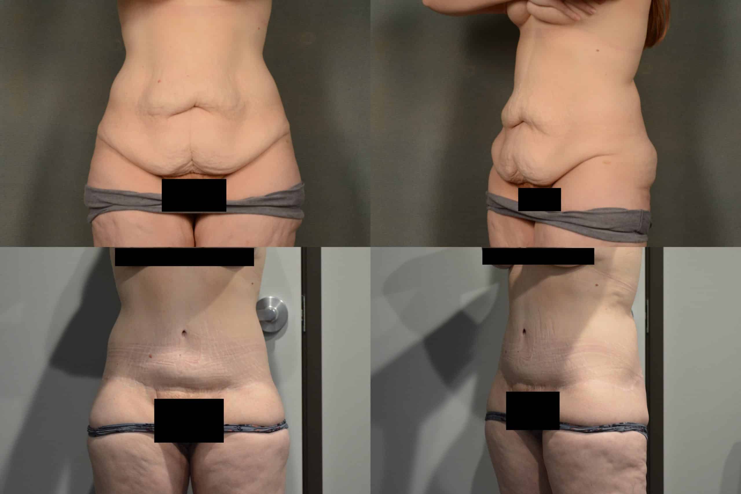 Tummy Tuck Case# 1066 Combined Image