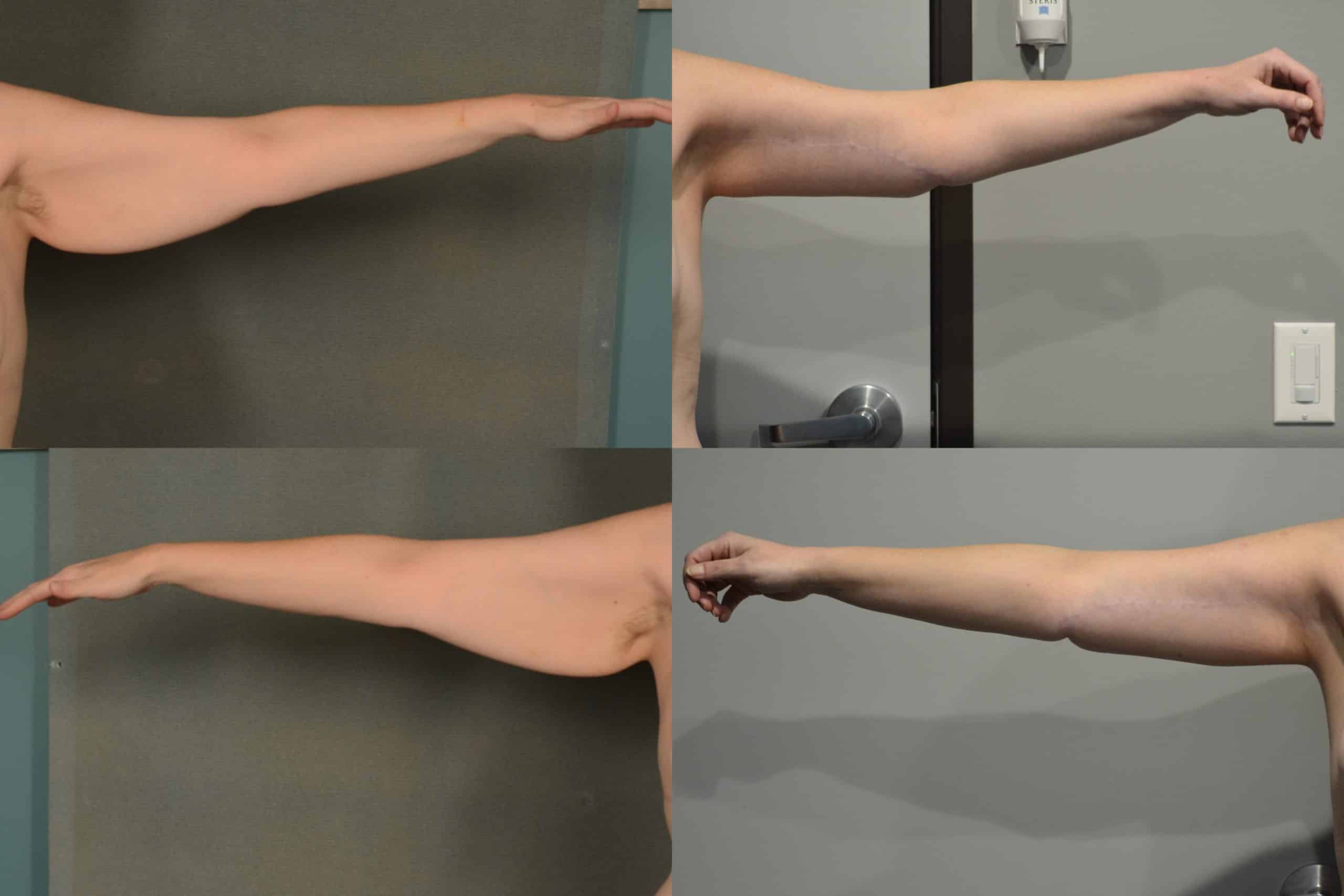 Arm Lift Case# 1067 Combined Image